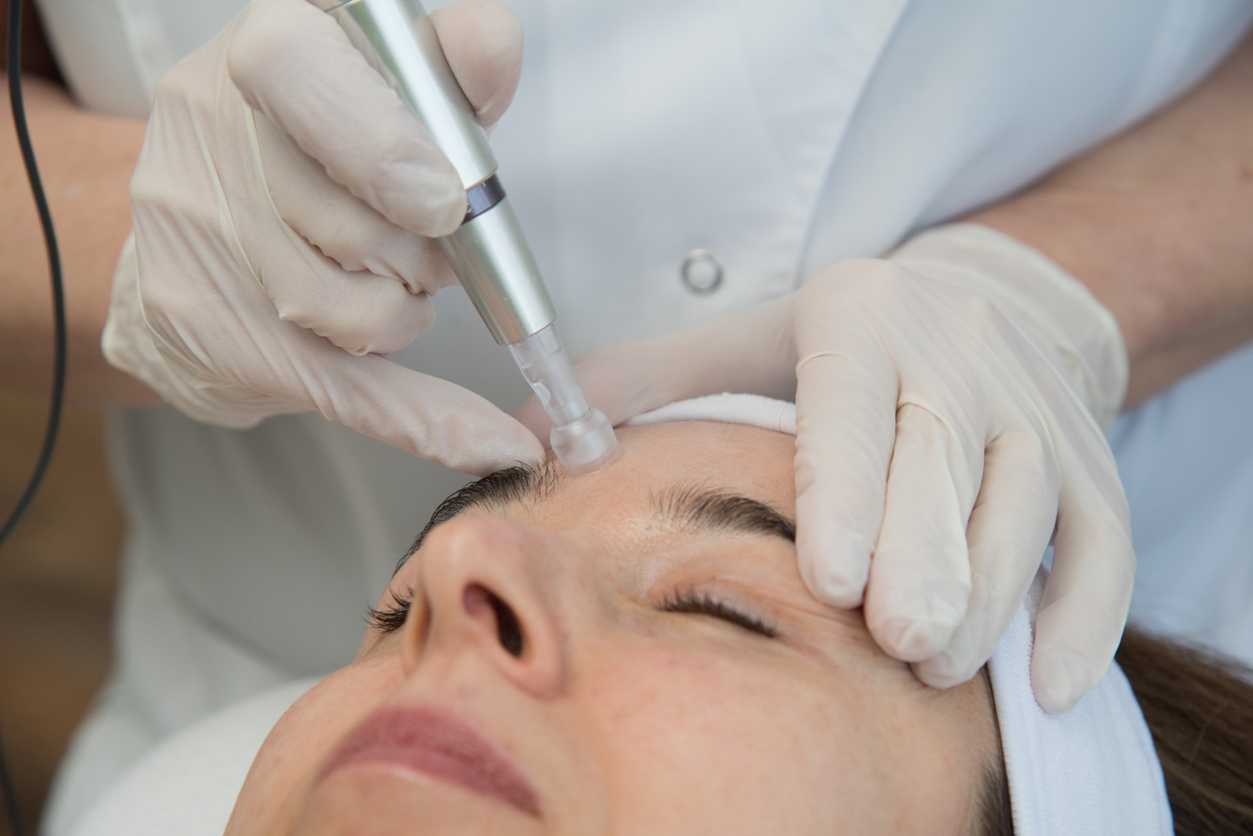 Microneedling